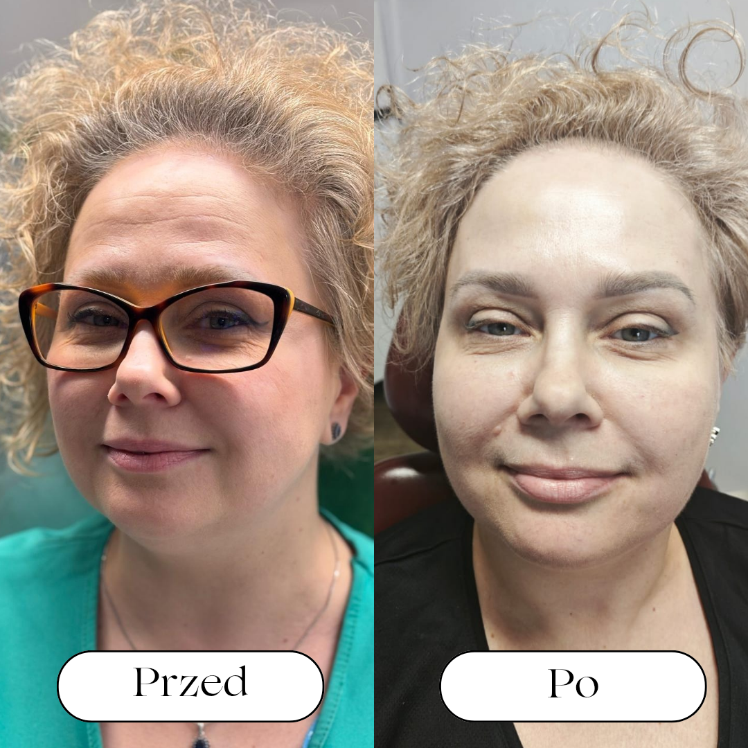 Toksyna botulinowa 💉