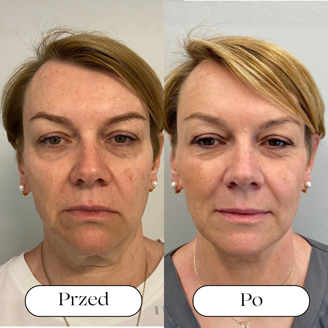 Kwas hialuronowy 👸