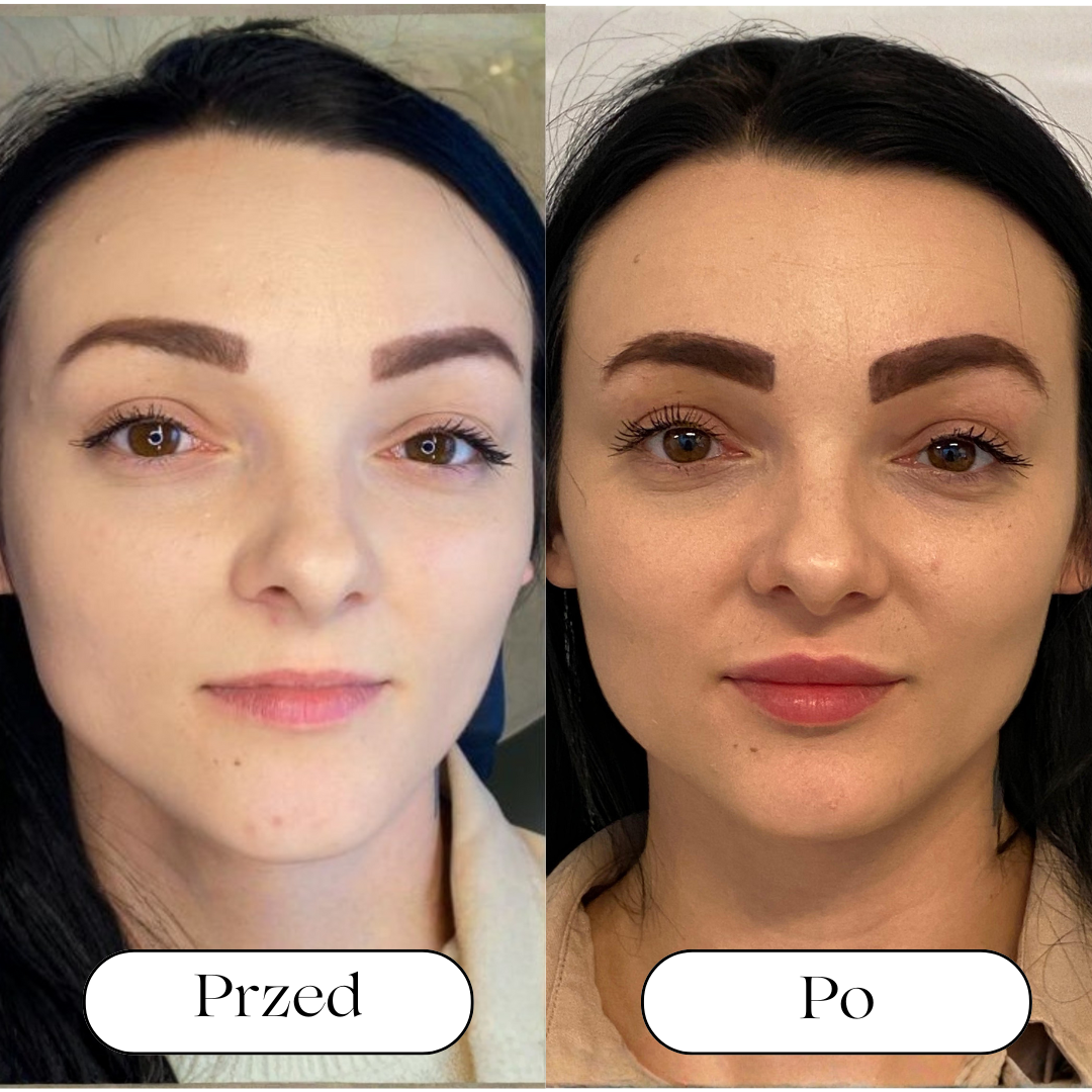 Powiększanie ust 👄